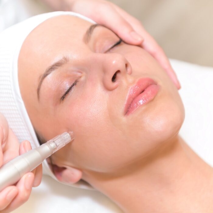 Microneedling